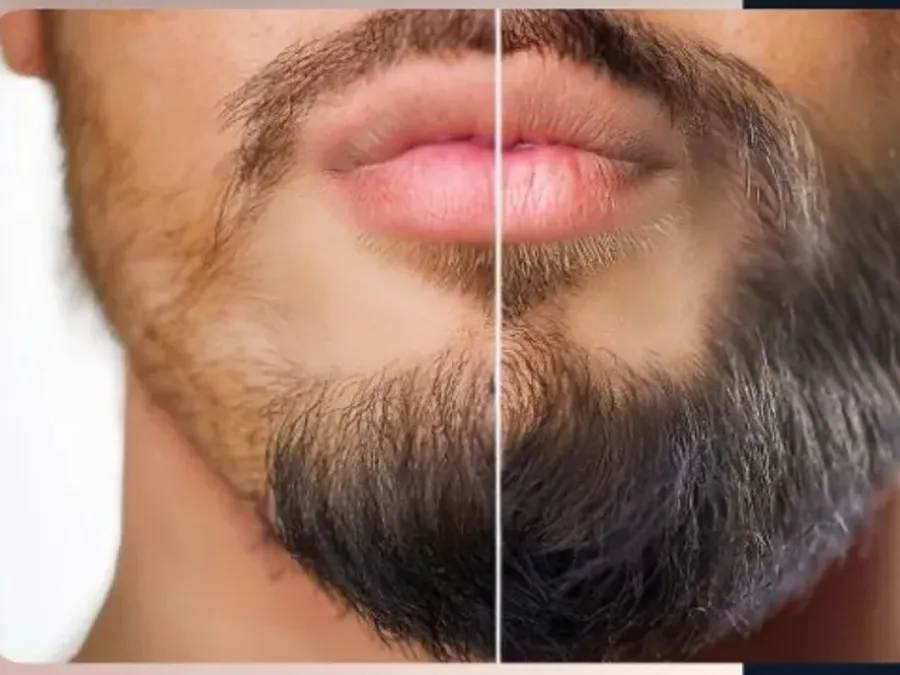 Transplante de barba