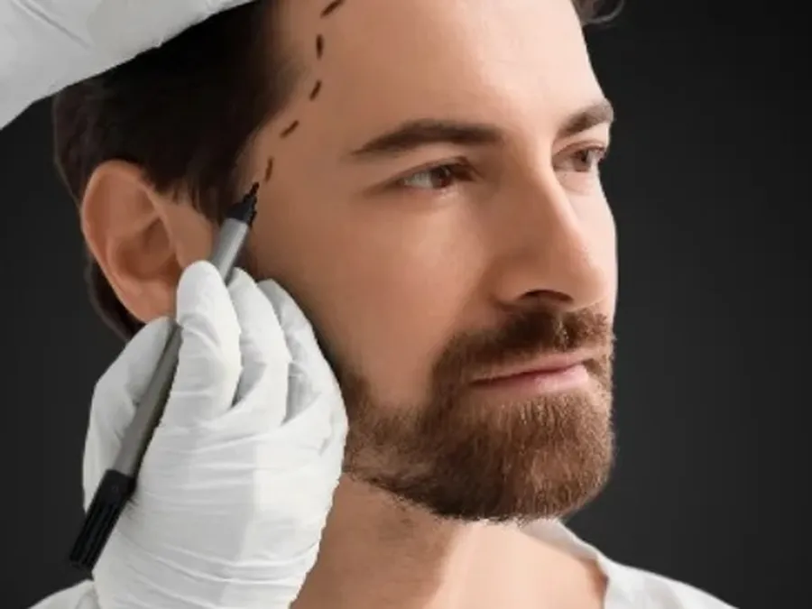 Transplante capilar